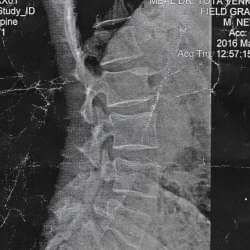 CT scan - Sciatic Pain